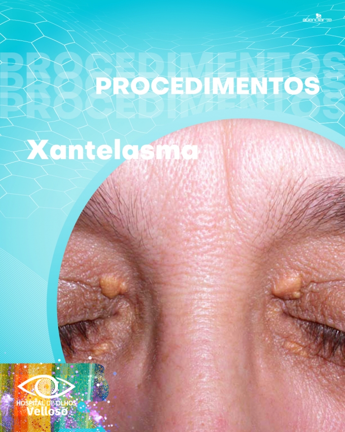 Procedimentos - Xantelasma