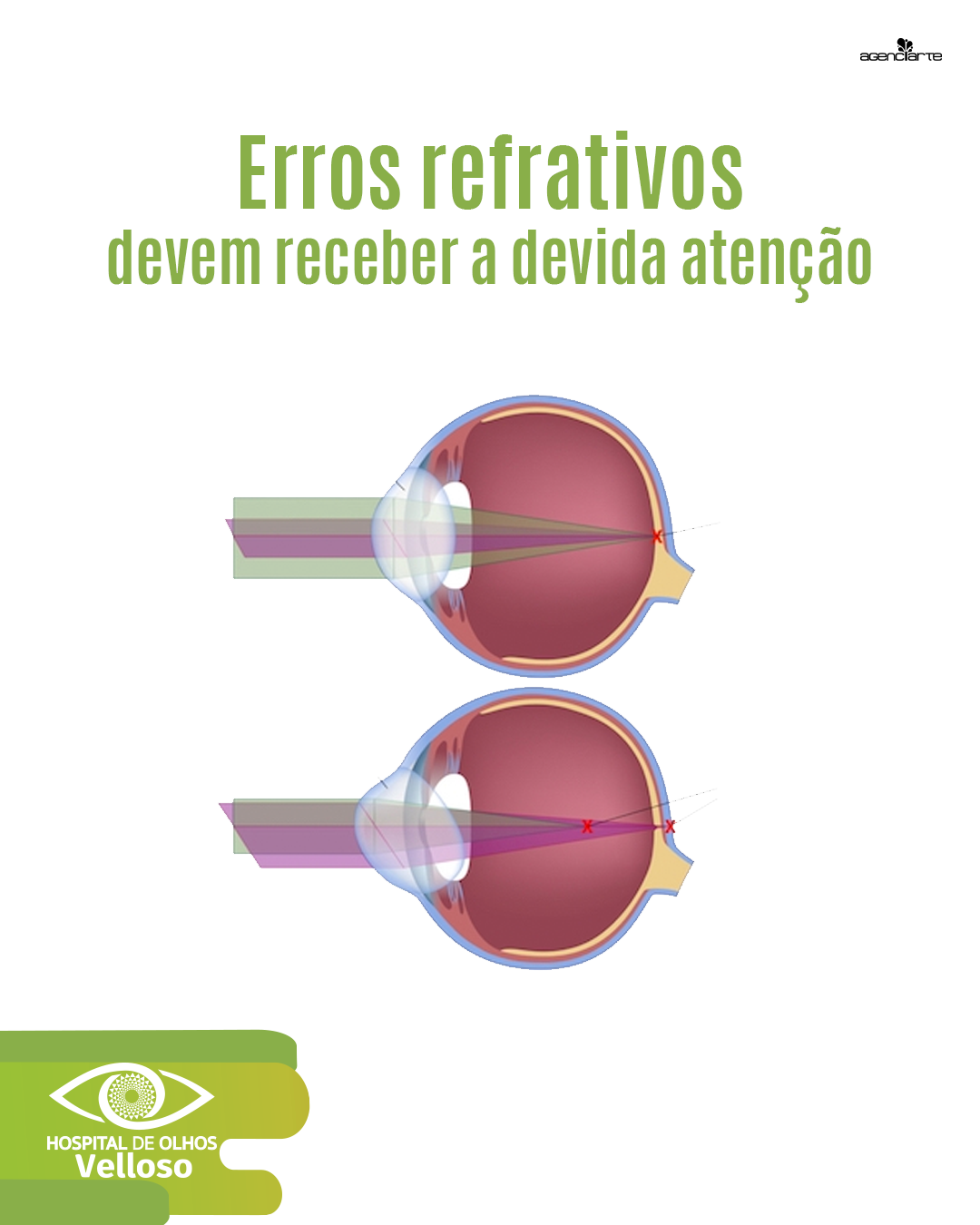 Erros refrativos devem receber a devida atenção