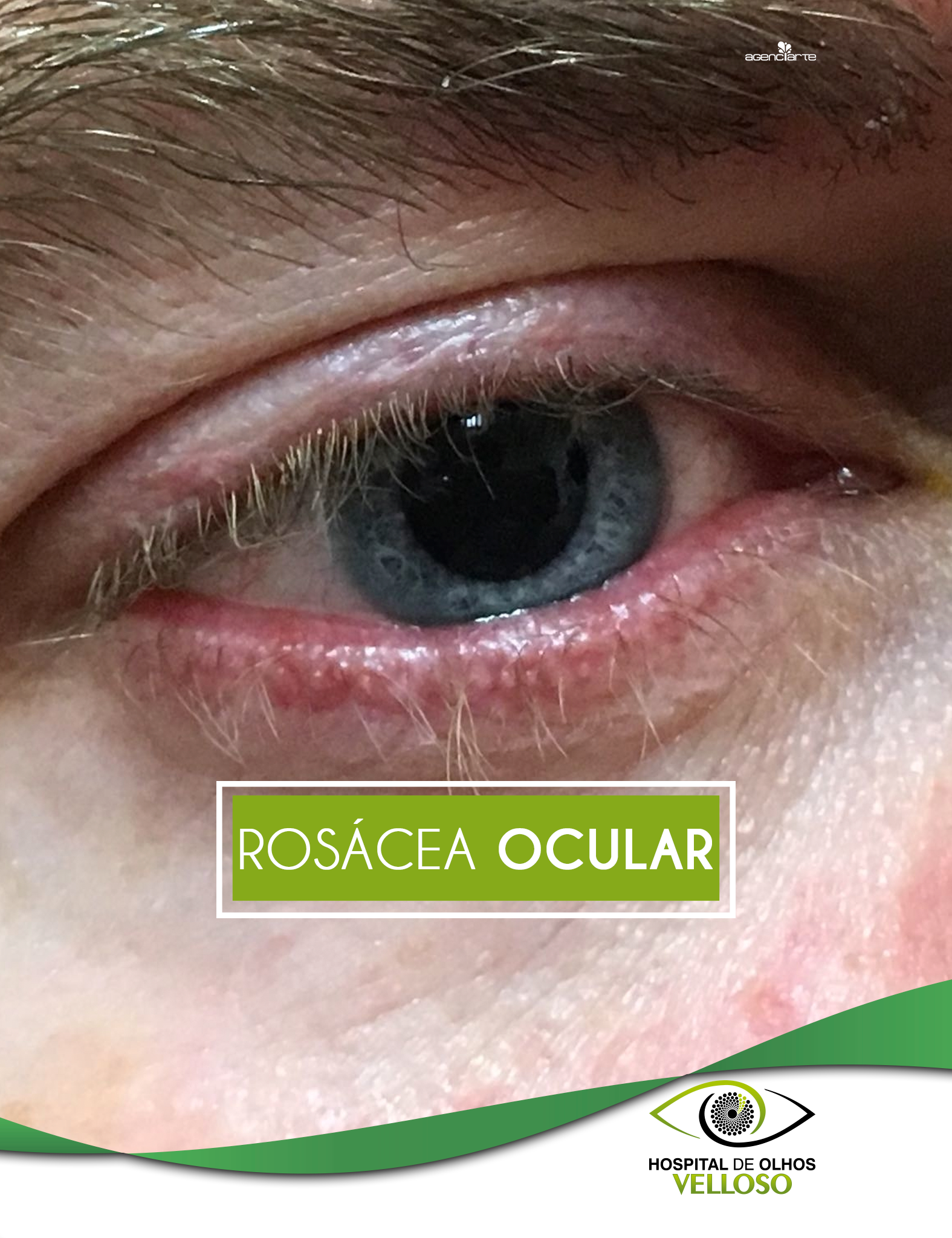 ROSÁCIA OCULAR
